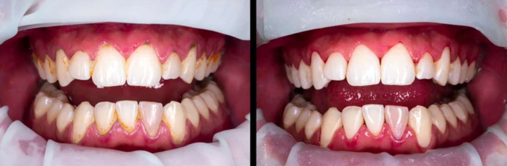 higienizacja skaling zębów warszawa