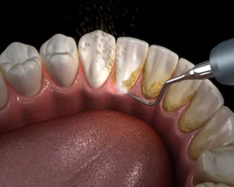 skaling zębów higienizacja warszawa
